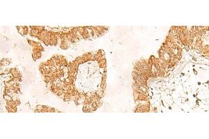 Immunohistochemistry of paraffin-embedded Human liver cancer tissue using POLR1D Polyclonal Antibody at dilution of 1:50(x200) (POLR1D Antikörper)