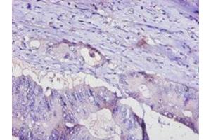 Immunohistochemistry of paraffin-embedded human colon cancer using ABIN7143414 at dilution of 1:100 (ADIPOQ Antikörper  (AA 19-244))
