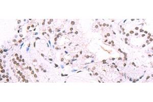Immunohistochemistry of paraffin-embedded Human thyroid cancer tissue using IRF2BP1 Polyclonal Antibody at dilution of 1:40(x200) (IRF2BP1 Antikörper)
