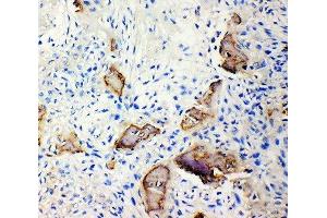 Anti-Bone Sialoprotein antibody, IHC(P) IHC(P): Human Osteosarcoma Tissue