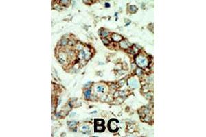 Formalin-fixed and paraffin-embedded human cancer tissue reacted with EPHA2 polyclonal antibody  , which was peroxidase-conjugated to the secondary antibody, followed by AEC staining. (EPH Receptor A2 Antikörper  (N-Term))