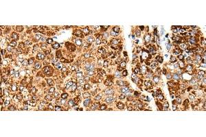 Immunohistochemistry of paraffin-embedded Human liver cancer tissue using CACNG5 Polyclonal Antibody at dilution of 1:50(x200) (CACNG5 Antikörper)