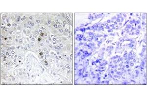 Immunohistochemistry analysis of paraffin-embedded human breast carcinoma tissue, using BATF Antibody.