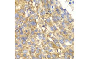 Immunohistochemistry of paraffin-embedded human esophageal cancer using EIF2AK4 antibody (ABIN5974303) at dilution of 1/100 (40x lens). (GCN2 Antikörper)