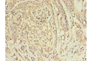 Immunohistochemistry of paraffin-embedded human breast cancer using ABIN7144576 at dilution of 1:100 (ARFIP2 Antikörper  (AA 20-295))
