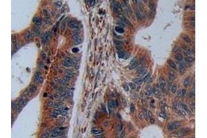 Detection of C2CD3 in Human Colorectal cancer Tissue using Polyclonal Antibody to C2 Calcium Dependent Domain Containing Protein 3 (C2CD3) (C2CD3 Antikörper  (AA 1432-1647))