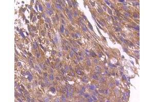 Paraformaldehyde-fixed, paraffin embedded human breast cancer, Antigen retrieval by boiling in sodium citrate buffer (pH6) for 15min, Block endogenous peroxidase by 3% hydrogen peroxide for 30 minutes, Blocking buffer at 37°C for 20min, Antibody incubation with ARF1 (1D4) Monoclonal Antibody  at 1:50 overnight at 4°C, followed by a conjugated secondary and DAB staining. (ARF1 Antikörper)