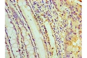 Immunohistochemistry of paraffin-embedded human colon cancer using ABIN7166888 at dilution of 1:100 (PYCR1 Antikörper  (AA 2-319))