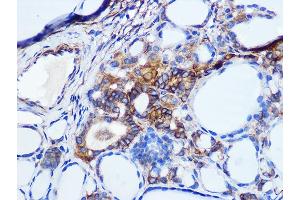 Immunohistochemistry of paraffin-embedded human thyroid cancer using Pan Cadherin Rabbit mAb (ABIN1679719, ABIN3019268, ABIN3019269 and ABIN7101741) at dilution of 1:100 (40x lens). (CDH1,CDH2,CDH3,CDH4 Antikörper)