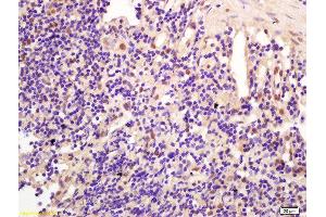 Formalin-fixed and paraffin embedded human gastric carcinoma labeled with Anti-CCDC147 Polyclonal Antibody, Unconjugated  at 1:200 followed by conjugation to the secondary antibody and DAB staining (CCDC147 Antikörper  (AA 161-260))