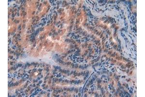DAB staining on IHC-P; Samples: Human Thyroid cancer Tissue