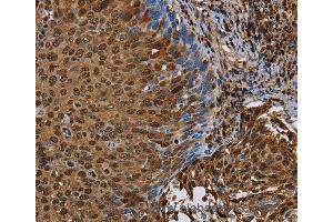 Immunohistochemistry of Human cervical cancer using NRP2 Polyclonal Antibody at dilution of 1:45