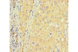 Immunohistochemistry of paraffin-embedded human liver cancer using ABIN7176405 at dilution of 1:100 (ZNF583 Antikörper  (AA 1-300))