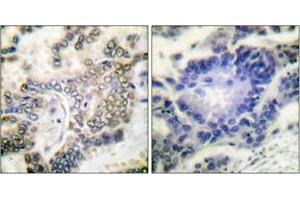Immunohistochemistry analysis of paraffin-embedded human lung carcinoma tissue, using C/EBP-alpha (Ab-21) Antibody. (CEBPA Antikörper  (AA 6-55))