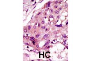 Formalin-fixed and paraffin-embedded human hepatocellular carcinoma tissue reacted with IRAK2 polyclonal antibody  , which was peroxidase-conjugated to the secondary antibody, followed by DAB staining. (IRAK2 Antikörper  (C-Term))