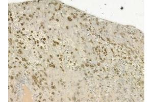 ABIN6265655 and ABIN6277246 at 1/100 staining human melanoma by IHC-P. (TNK2 Antikörper  (C-Term))