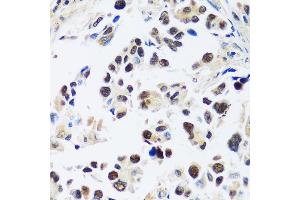 Immunohistochemistry of paraffin-embedded human lung cancer using  antibody (ABIN7265374) at dilution of 1:100 (40x lens). (ASCL4 Antikörper  (AA 1-172))