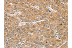 The image on the left is immunohistochemistry of paraffin-embedded Human liver cancer tissue using ABIN7192739(TBC1D21 Antibody) at dilution 1/30, on the right is treated with synthetic peptide. (TBC1D21 Antikörper)