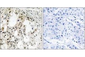 Immunohistochemistry analysis of paraffin-embedded human breast carcinoma tissue, using EIF3D Antibody. (EIF3D Antikörper  (AA 101-150))