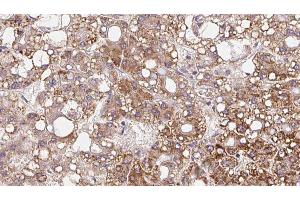 ABIN6272349 at 1/100 staining Human liver cancer tissue by IHC-P. (Mrgprf Antikörper  (C-Term))