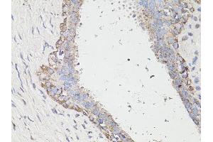 Immunohistochemistry of paraffin-embedded human breast cancer using MAP1LC3B antibody (ABIN6291774) at dilution of 1:100 (40x lens). (LC3B Antikörper)