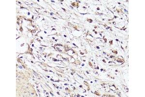 Immunohistochemistry of paraffin-embedded Human stomach cancer using VEGF Monoclonal Antibody at dilution of 1:150 (40x lens). (VEGF Antikörper)