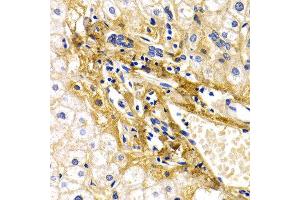Immunohistochemistry of paraffin-embedded human liver damage using CFH antibody at dilution of 1:200 (400x lens). (Complement Factor H Antikörper)