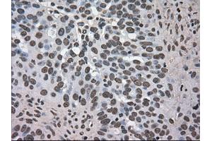 Immunohistochemical staining of paraffin-embedded Adenocarcinoma of colon tissue using anti-DHFRmouse monoclonal antibody. (Dihydrofolate Reductase Antikörper)