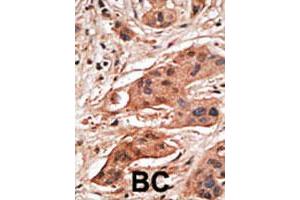 Formalin-fixed and paraffin-embedded human cancer tissue reacted with the BCL2A1 polyclonal antibody  , which was peroxidase-conjugated to the secondary antibody, followed by DAB staining. (BCL2A1 Antikörper  (N-Term))