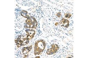 Immunohistochemistry analysis of paraffin-embedded human gastric cancer using LI Cadherin (ABIN7074493) at dilution of 1: 1500 (LI Cadherin Antikörper)