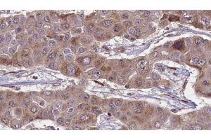 ABIN6269021 at 1/100 staining Human liver cancer tissue by IHC-P. (FSHR Antikörper  (Internal Region))