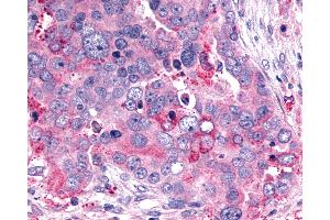 Anti-GHRHR antibody IHC of human Ovary, Carcinoma. (GHRHR Antikörper  (C-Term))
