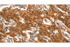 Immunohistochemistry of paraffin-embedded Human gasrtic cancer tissue using DEAF1 Polyclonal Antibody at dilution 1:40 (DEAF1 Antikörper)