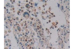 Detection of DEFa4 in Human Lung cancer Tissue using Polyclonal Antibody to Defensin Alpha 4, Corticostatin (DEFa4) (DEFA4 Antikörper  (AA 23-97))