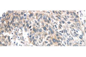 Immunohistochemistry of paraffin-embedded Human lung cancer using IQGAP2 Polyclonal Antibody at dilution of 1/40 (IQGAP2 Antikörper)