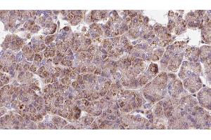 ABIN6273292 at 1/100 staining Human pancreas cancer tissue by IHC-P.