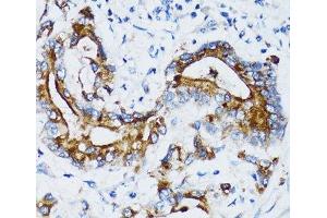Immunohistochemistry of paraffin-embedded Human colon carcinoma using MMP7 Polyclonal Antibody at dilution of 1:100 (40x lens). (MMP7 Antikörper)