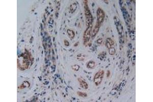 IHC-P analysis of Human Breast Cancer Tissue, with DAB staining. (PAK1 Antikörper  (AA 252-501))