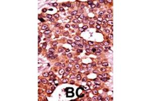 Formalin-fixed and paraffin-embedded human cancer tissue reacted with the primary antibody, which was peroxidase-conjugated to the secondary antibody, followed by AEC staining. (CDC6 Antikörper  (pSer54))