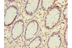 Immunohistochemistry of paraffin-embedded human colon cancer using ABIN7144679 at dilution of 1:100 (NAT2 Antikörper  (AA 1-290))
