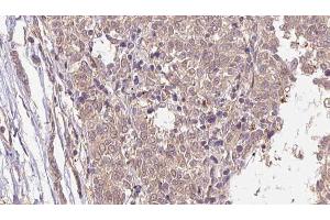 ABIN6266584 at 1/100 staining Human Melanoma tissue by IHC-P. (MLANA Antikörper  (Internal Region))
