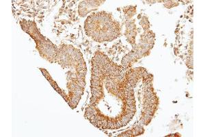 IHC-P Image Immunohistochemical analysis of paraffin-embedded human gastric cancer, using 39331, antibody at 1:100 dilution. (Septin 7 Antikörper)