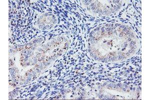 Immunohistochemical staining of paraffin-embedded Adenocarcinoma of Human endometrium tissue using anti-HES1 mouse monoclonal antibody. (HES1 Antikörper)