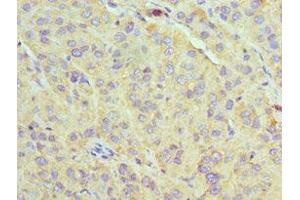 Immunohistochemistry of paraffin-embedded human liver cancer using ABIN7170632 at dilution of 1:100 (U2AF1 Antikörper  (AA 1-240))