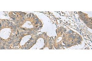 Immunohistochemistry of paraffin-embedded Human colorectal cancer tissue using CXCR5 Polyclonal Antibody at dilution of 1:80(x200) (CXCR5 Antikörper)