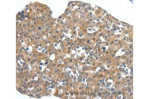 Immunohistochemistry of Human breast cancer using SCN11A Polyclonal Antibody at dilution of 1:40 (SCN11A Antikörper)
