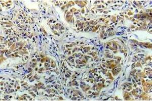 Immunohistochemistry (IHC) analyzes of eIF4E antibody in paraffin-embedded human breast carcinoma tissue. (EIF4E Antikörper)