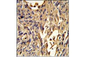 Immunohistochemistry analysis in Formalin Fixed, Paraffin Embedded Human lung carcinoma using S100A10 Antibody (Center) followed by peroxidase conjugation of the secondary antibody and DAB staining.