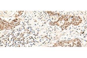 Immunohistochemistry of paraffin-embedded Human esophagus cancer tissue using HOXD9 Polyclonal Antibody at dilution of 1:30(x200) (HOXD9 Antikörper)