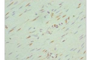 Immunohistochemistry of paraffin-embedded human colon cancer using ABIN7168762 at dilution of 1:100 (SEPHS1 Antikörper  (AA 1-392))